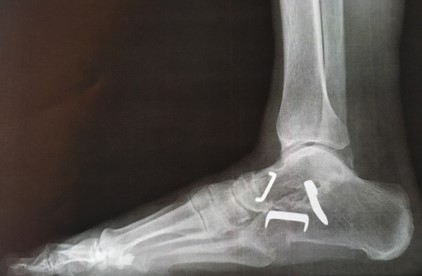 artrodesis pie lateral